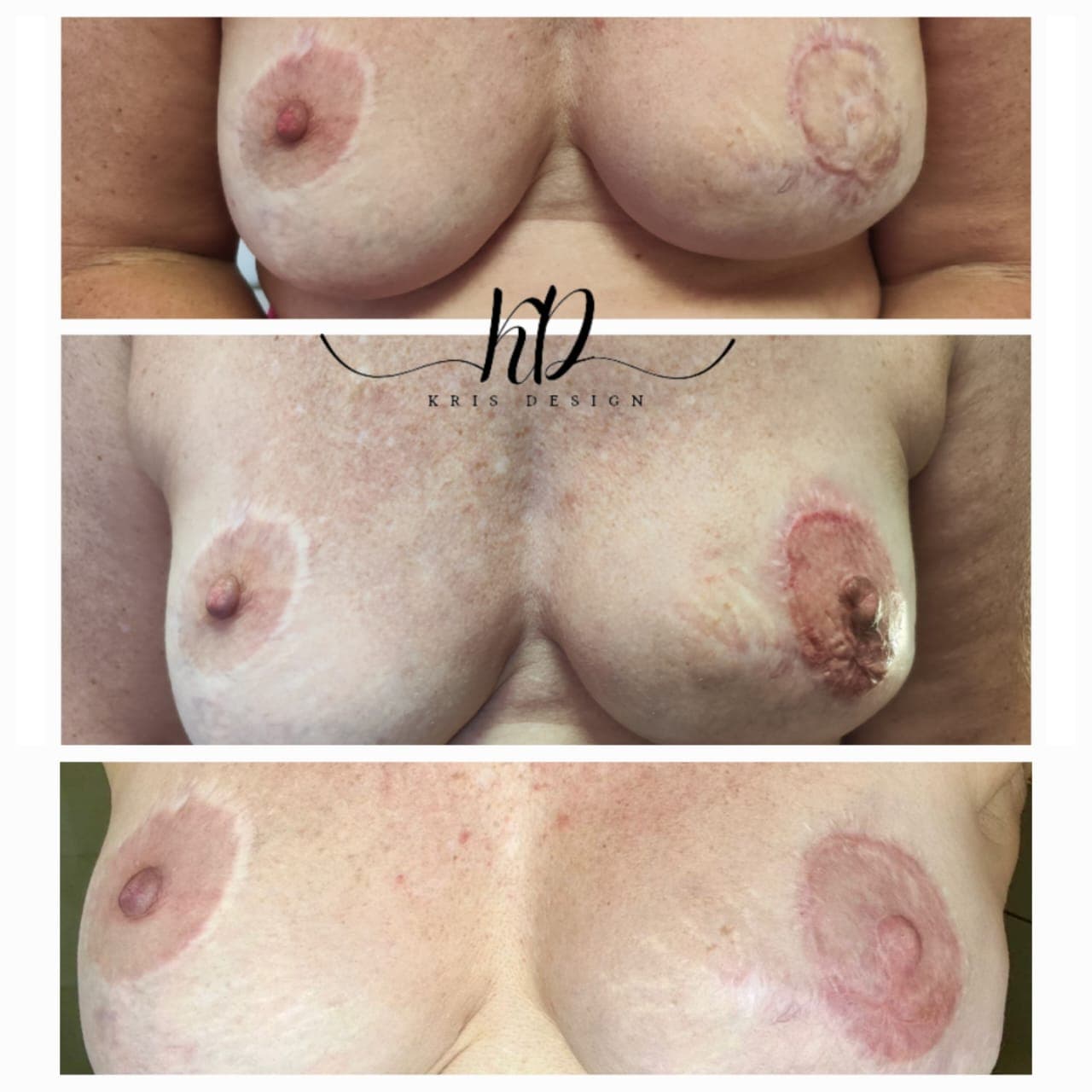 Dermopigmentation réparatrice sur greffe de téton.